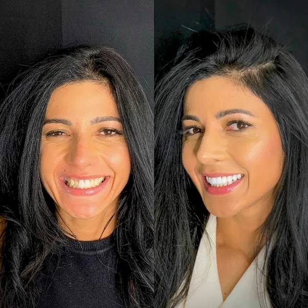 Juliana, paciente da Odonto Viva, antes e depois das lentes de contato dental